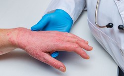 Pomyślne pierwsze testy kliniczne nowego leku na atopowe zapalenie skóry