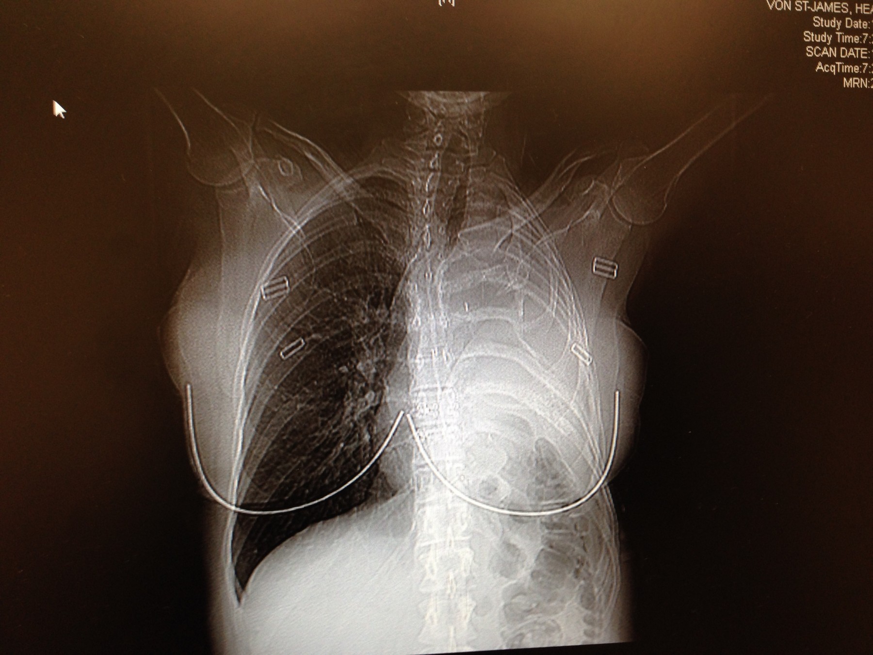 Heather v detstve opakovane nosila otcovu bundu kontaminovanú azbestovým prachom.