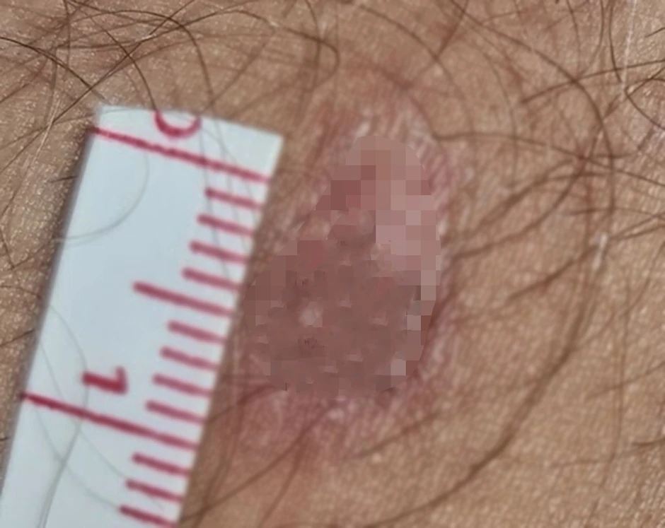 Ujed nekad bude i do dva centimetra