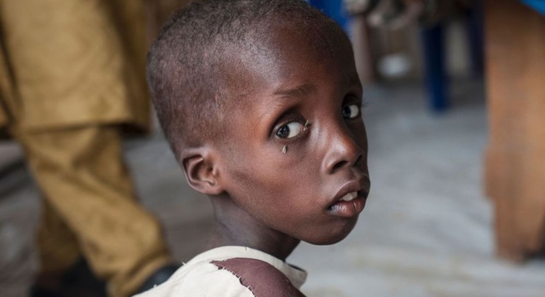 Malnourished boy at an IDP camp in Borno