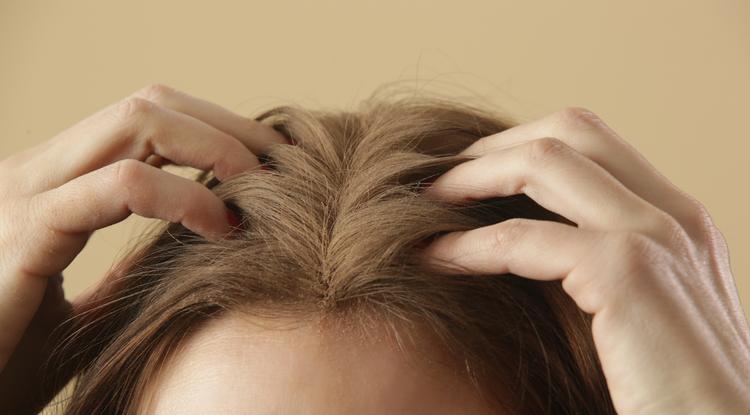 Íme a megoldás a száraz fejbőrre. Fotó: Getty Images