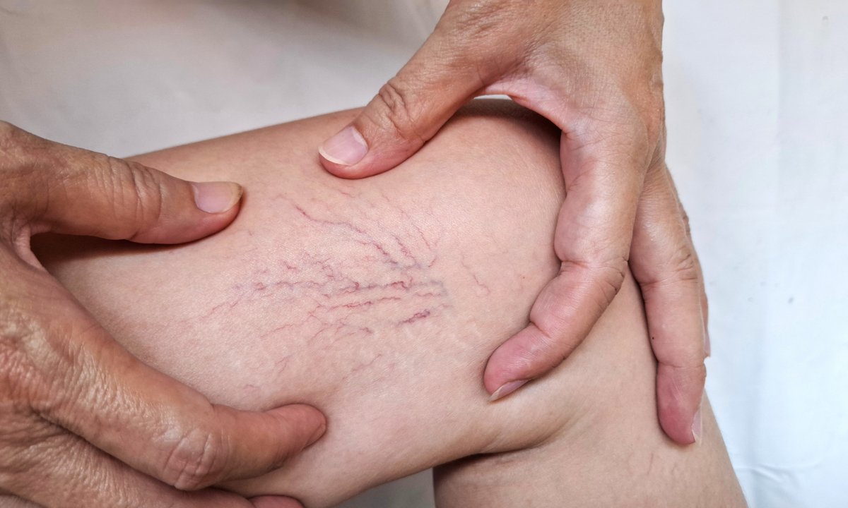 Ten krem z mirrą to pogromca pajączków na nogach. Poprawia krążenie i wzmacnia naczynia