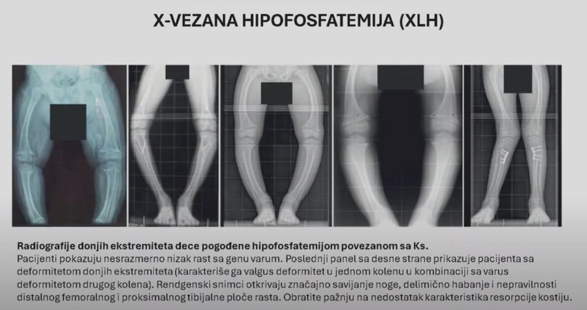 Prepoznavanje retkih bolesti po izgledu nogu