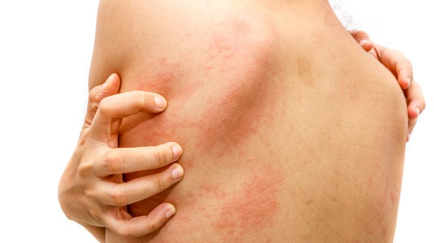 ízületi fájdalom és allergiás kiütés