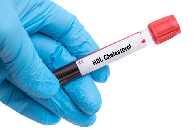 Mit jelent a HDL-koleszterin érték a laborleleten?