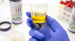 ¿Un análisis de orina reemplazará a una biopsia?  Una sencilla prueba detecta algunos tipos de cáncer