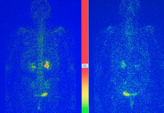 Scyntygrafia: wskazania, skutki uboczne, czy jest szkodliwa? Na czym polega badanie scyntygrafii