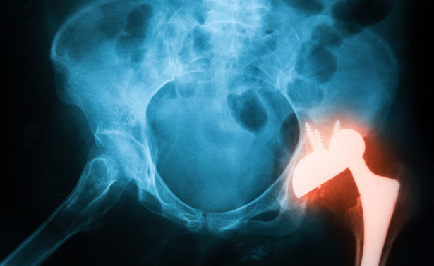 Ortopeda: Wymiana implantu biodra to dziś operacja jednego dnia. WYWIAD