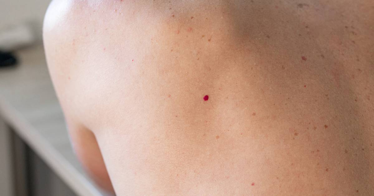 Wielu z nas ignoruje małe, czerwone plamki na skórze. Lekarze mówią, czy są groźne