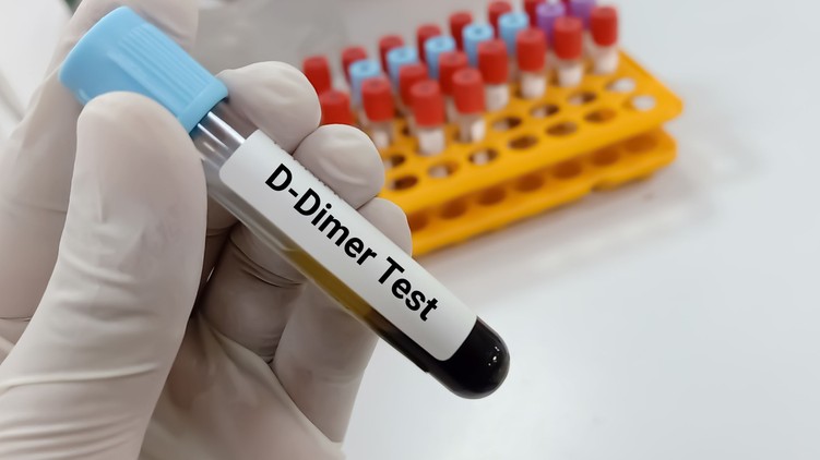 mitől emelkedhet D-dimer vérvétel labor