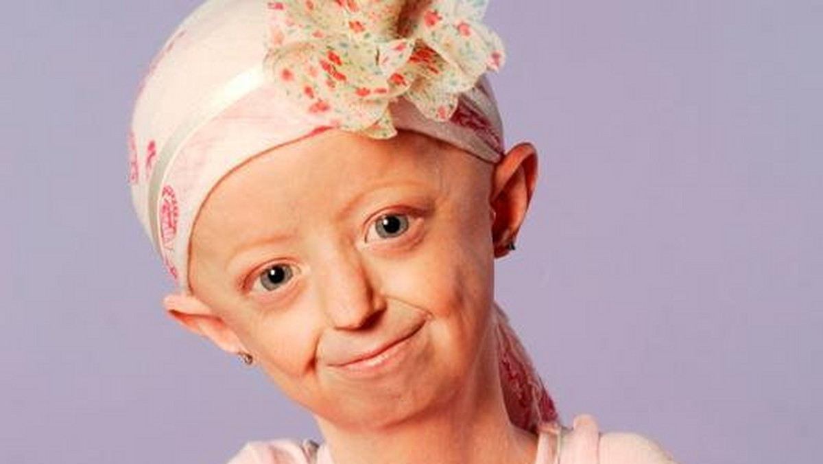 Cierpiąca na progerię Hayley Okines nie żyje. Choć miała zaledwie 17 lat, lekarze określali stan jej ciała na ponad sto lat - informuje "The Telegraph".