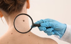 Szybka diagnoza, proste badanie – jak skutecznie walczyć z czerniakiem?