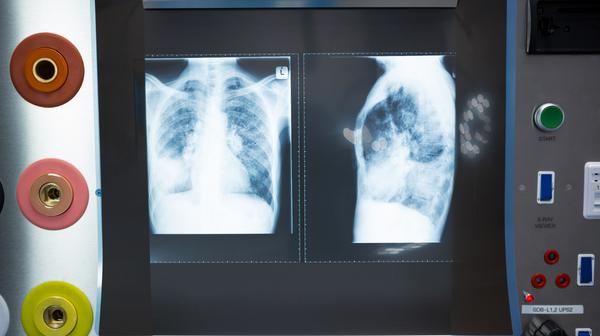 Tętnicze nadciśnienie płucne to rzadka postać dużej grupy chorób przebiegających z podwyższonym ciśnieniem w tętnicach płucnych.