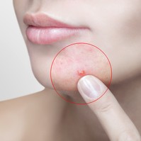 Szteroid okozta akné, pattanás ellen ezek a bőrgyógyász tanácsai