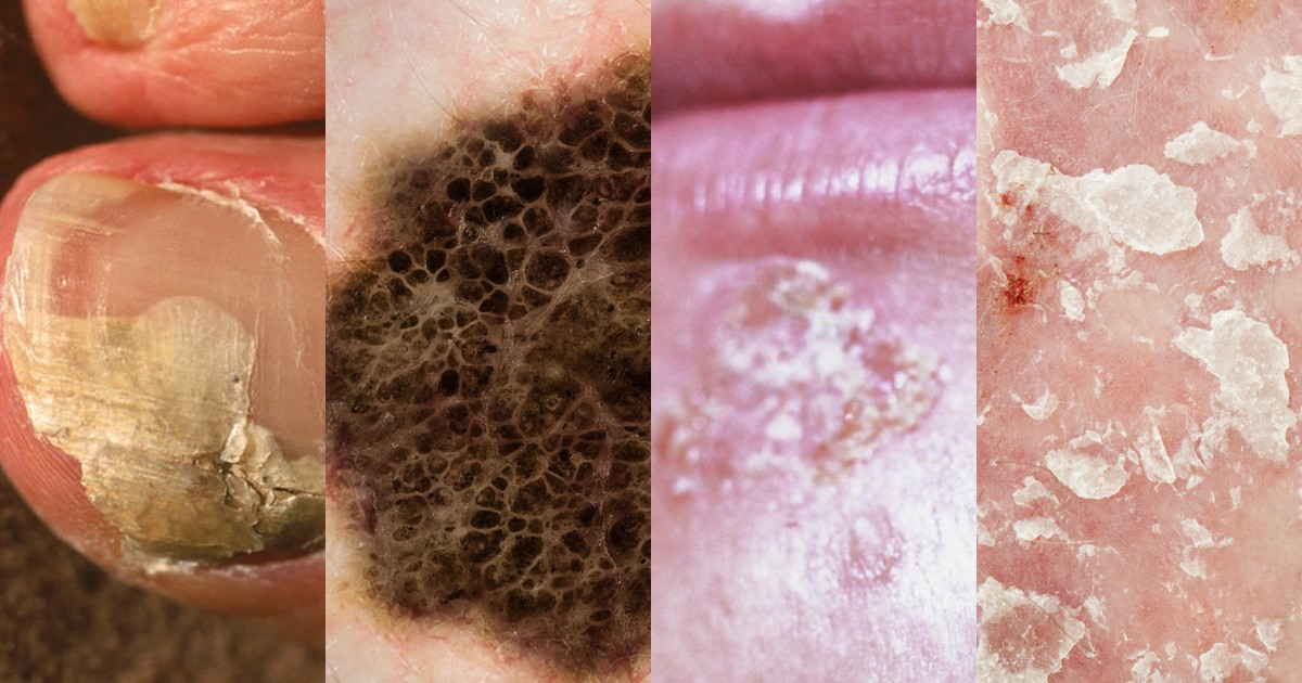 Podaj Cztery Różne Propozycje Dotyczące Profilaktyki Chorób Skóry 9 typowych chorób skóry - Zdrowie