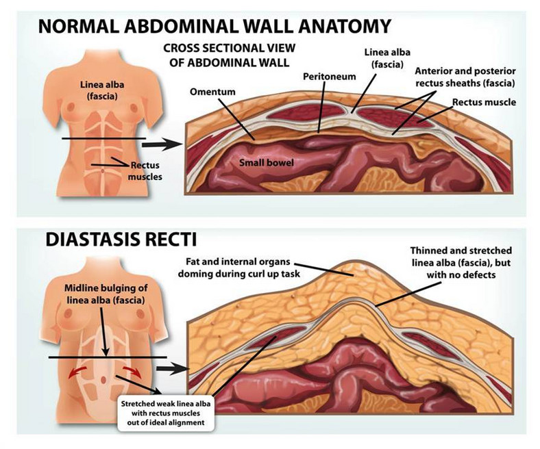 All about postpartum diastasis recti and how to get rid of it [Credit:  Burrell Education] 