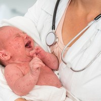 Dupla erővel pusztít a kanyaró: tényleg az oltásellenes mozgalom eredményezte?