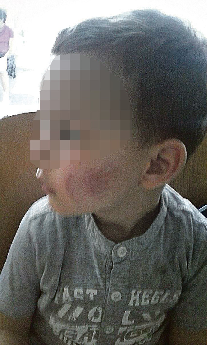 Dečak je pokušavao da izađe iz spavaonice, ali je ona bila zaključana: V. Đ. (3) izujedan je po licu, ušima, ruci...