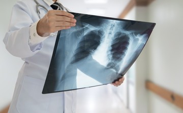 Az orvos elárulja, hogy mit tegyen a COPD-s beteg, ha fellángolnak a tünetei