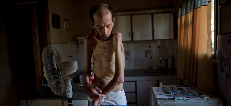 Zdeformowane dzieci, schorowani dorośli. Wstrząsający fotoreportaż z Argentyny. ZDJĘCIA