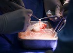 How doctors transferred pig's kidney into human patient for the first time