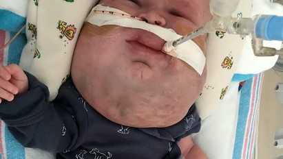 Brutális fotók: több száz cisztával az arcában született a kisbaba – fotók (18+)