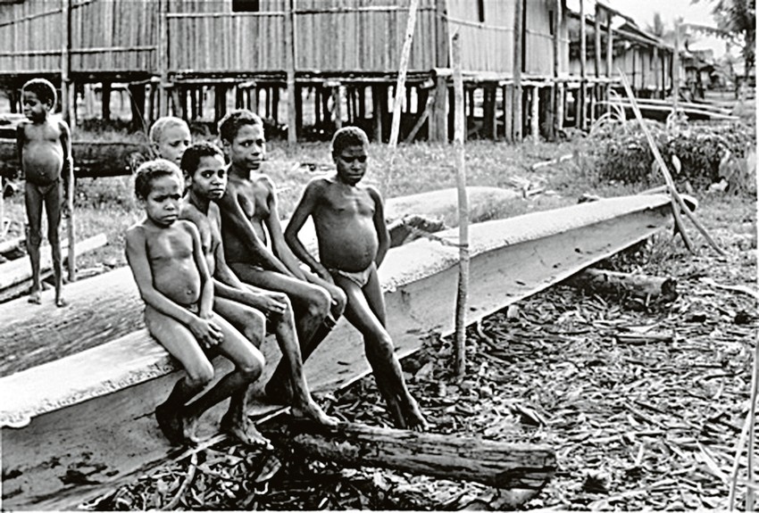 Mnoge žrtve pate od nekontrolisanih napada smeha - i umiru manje od godinu dana nakon što su prvi put pokazali simptome bolesti