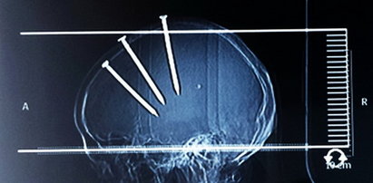 Chińczyk wbił sobie gwoździe w głowę