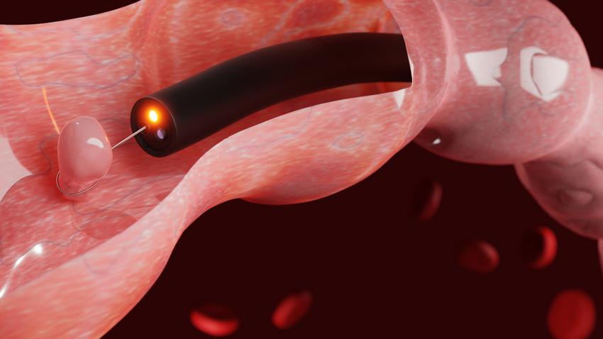 rosszindulatú vastagbéldaganat, szűrővizsgálat, kolonoszkópia, rák, bélrák, diagnosztizálás, bélrendszer