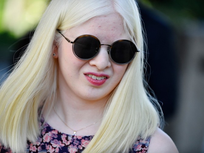 Albino manekenka koju su roditelji napustil foto: JULIEN DE ROSA/: AFP
