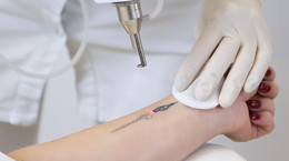 Usuwanie tatuażu – jak wygląda i ile kosztuje?
