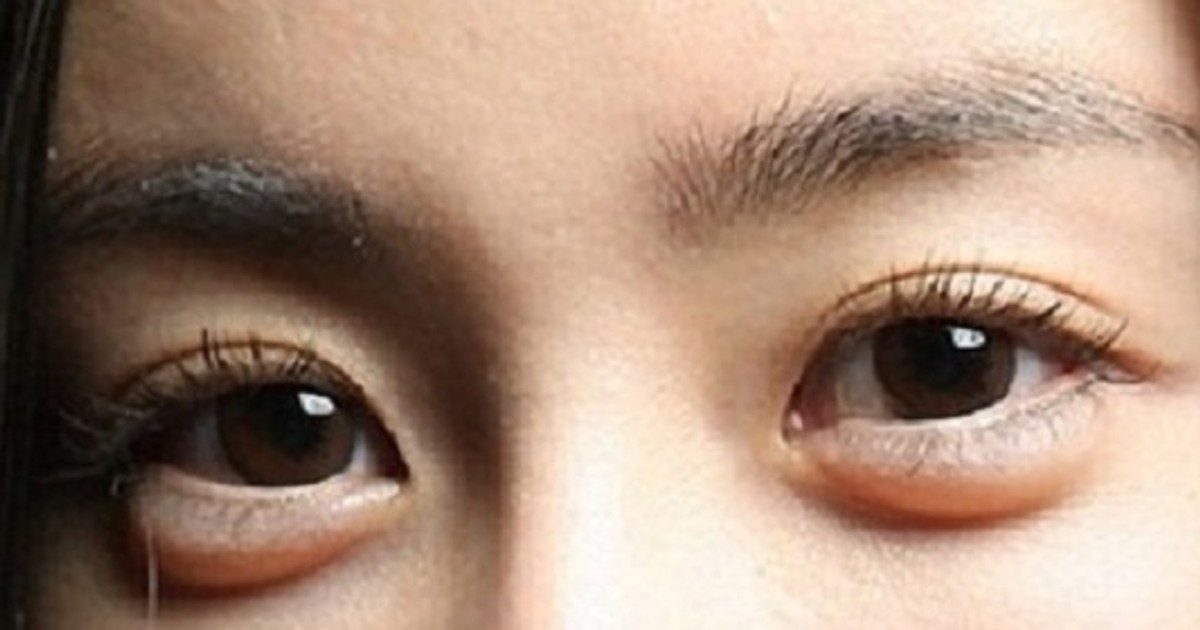 5 best ways to treat undereye puffiness at home Pulse Ghana