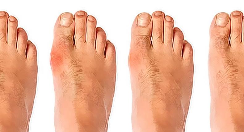 Bunion development, from mild to severe