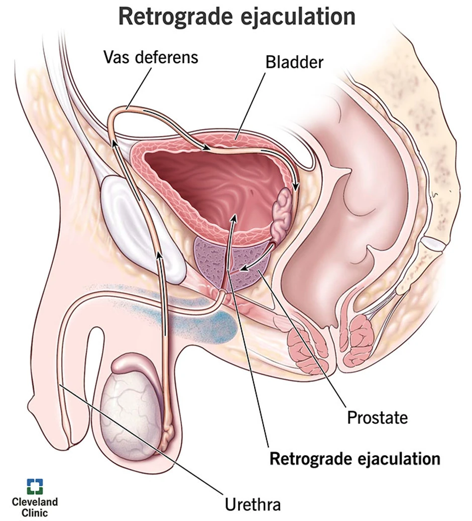 Retrogradna ejakulacija uzrokuje da sperma uđe u bešiku umesto da izlazi kroz penis tokom orgazma