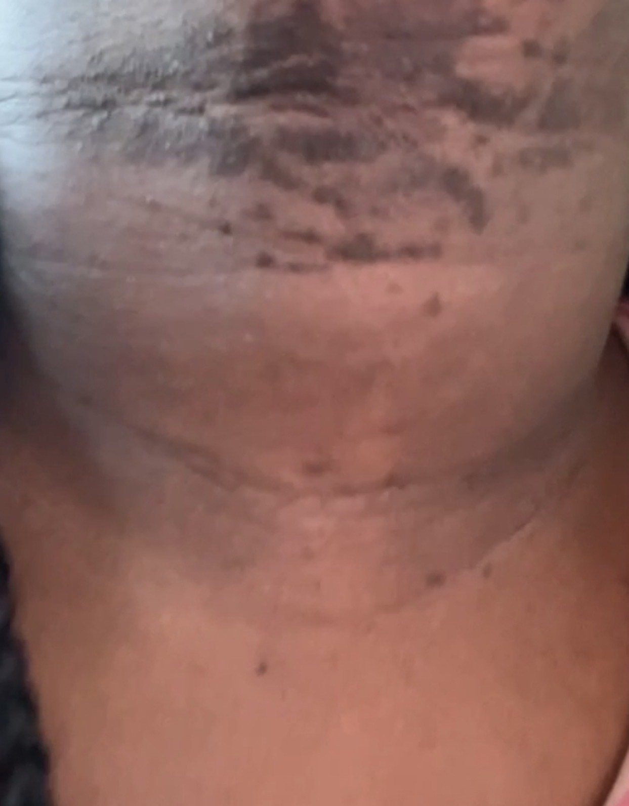 Khadejah Sutherland si všimla na koži vážnu zmenu. 