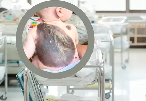 Chłopiec urodził się z nietypową zmianą na skórze. Taki przypadek zdarza się raz na 500 tys.