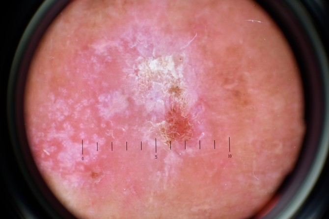 Od melanoma u Srbiji godišnje oboli oko 600 ljudi, a više od 200 njih ima metastatski melanom
