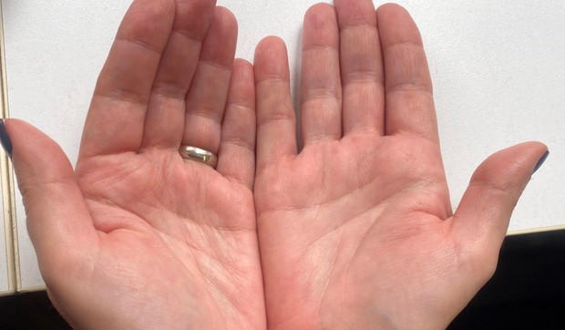 Crvenilo se obično javlja na donjem delu dlana, ali može da se širi i na prste