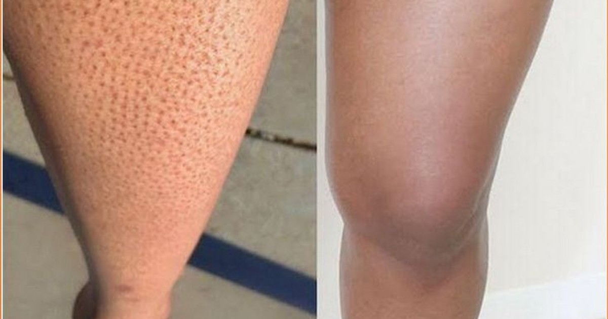 What you need to know about 'strawberry legs' and their treatment