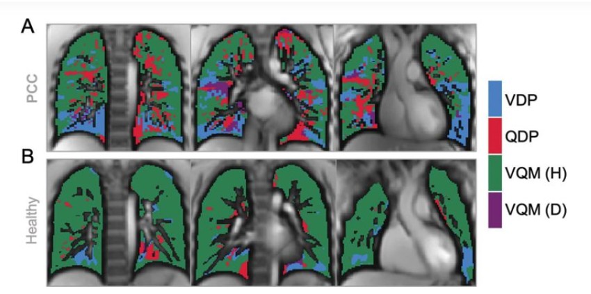 U poređenju sa zdravom, deca sa dugim COVID-om imali su značajno smanjen protok krvi u plućima