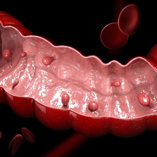 Vastagbélrák (colon carcinoma, colorectalis carcinoma)