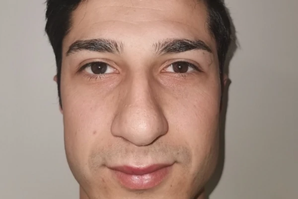 NEVIĐENA TRANSFORMACIJA! Turčin od "RUŽNOG PAČETA" postao jedan od NAJLEPŠIH muškaraca na svetu: Uradio je samo ove 3 OPERACIJE na licu i doslovno postao NOVI ČOVEK