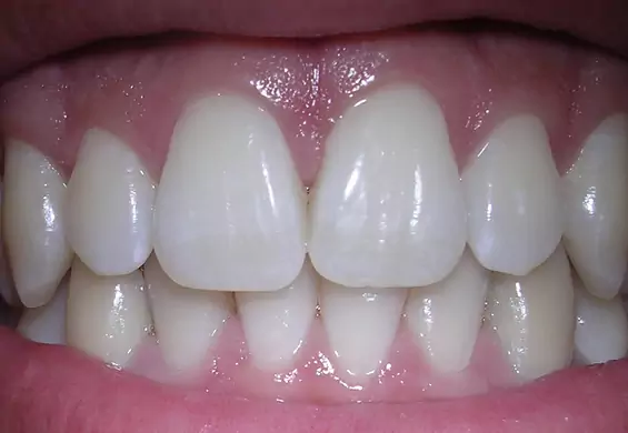 6 wypróbowanych sposobów na białe zęby. Wszystkie składniki masz w kuchni