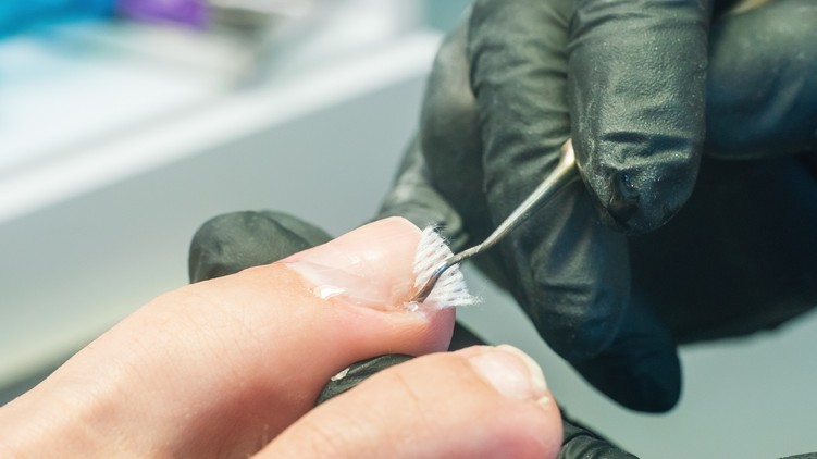 Benőtt köröm nemcsak szűk cipő okozhatja