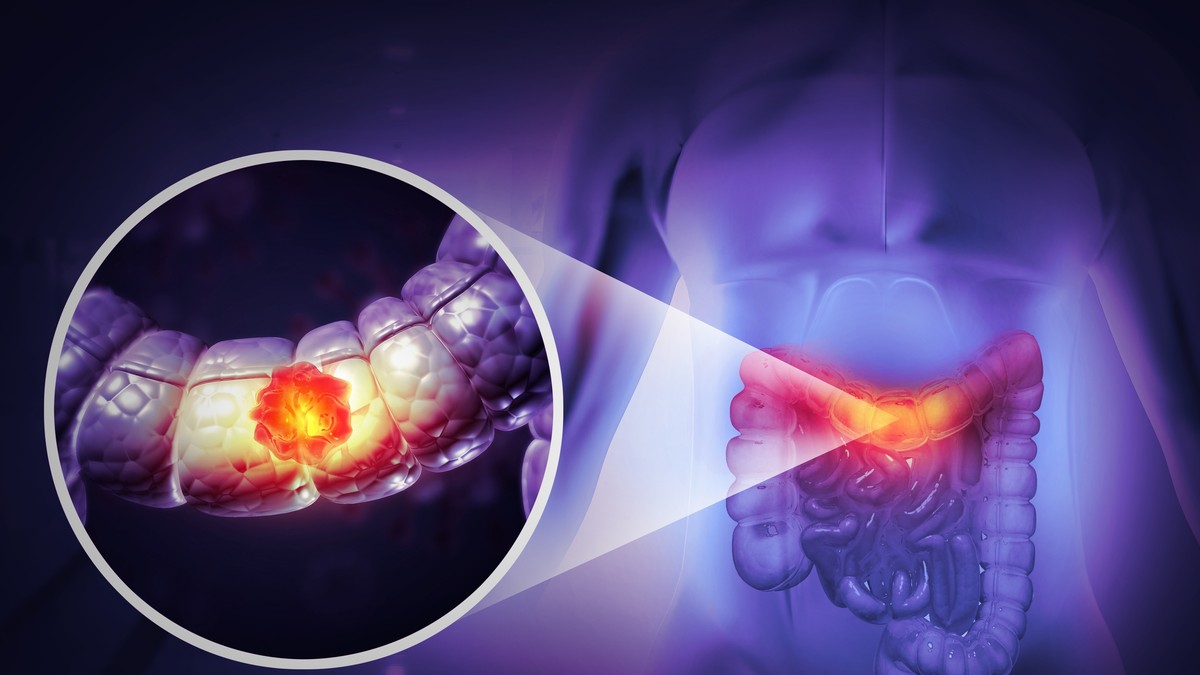 Analiza tumora iz 1950-ih može da pomogne u otkrivaju uzroka porasta raka debelog creva kod mladih