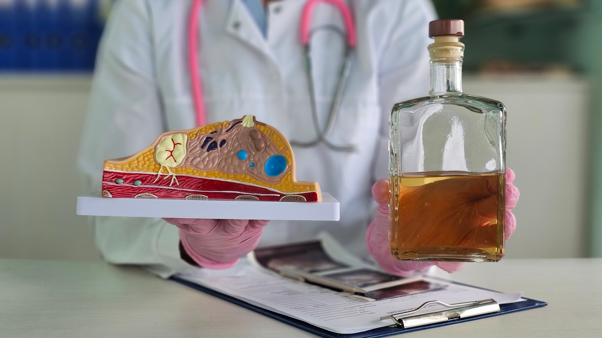 Lekár drží fľašu alkoholu pri zdravotníckych materiáloch o ženskom prsníku. Svetová zdravotnícka organizácia upozorňuje, že konzumácia alkoholu zvyšuje riziko rakoviny prsníka, a to aj pri relatívne nízkych dávkach. Podľa údajov WHO o tejto súvislosti vie iba 15 % opýtaných v 14 krajinách Európskej únie. (Ilustračný obrázok)