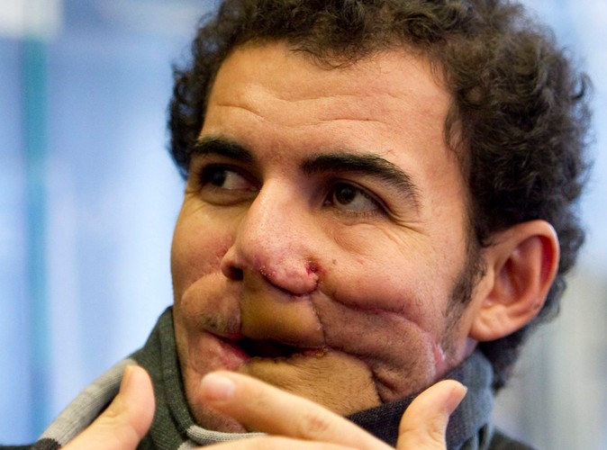 Mohamed wystąpił na konferencji prasowej wraz z chirurgami. On nie krył szczęścia, a jego lekarze – zadowolenia i dumy ze świetnie wykonanego zadania.