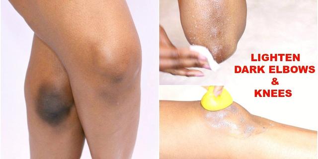 Here are 5 ways to naturally get rid of dark elbows and knees