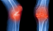  Osteofitoza - przebieg, przyczyny, objawy. Jak leczyć zmiany zwyrodnieniowe kości? 
