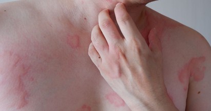 Az anafilaxia tünetei két hullámban jelentkezhetnek! Erre figyelmeztet az allergológus